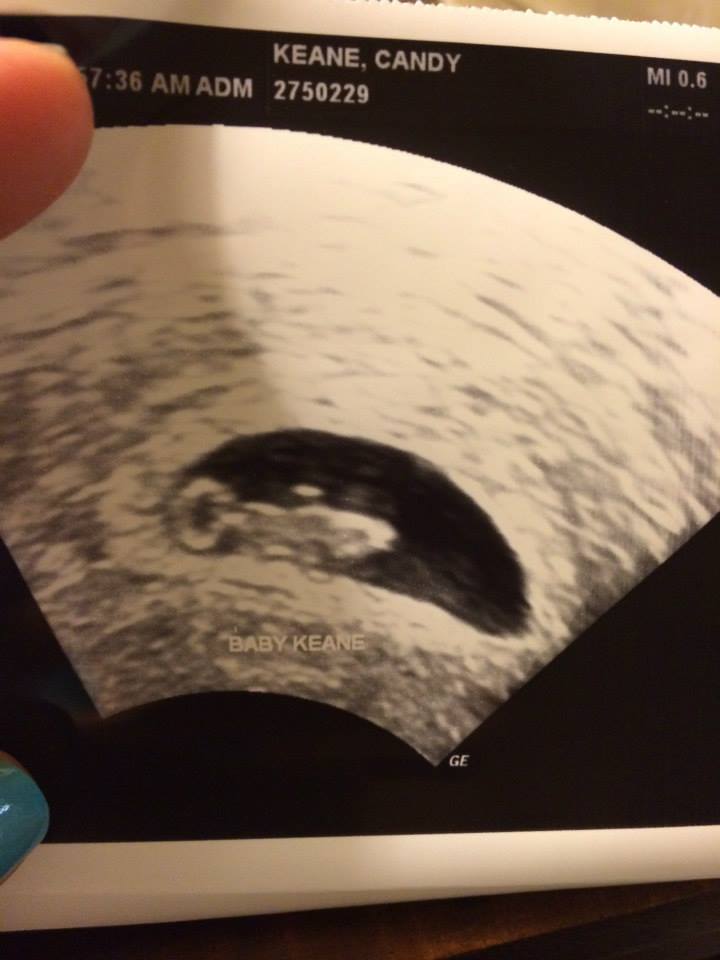 Pregnancy 7 weeks ultrasound
